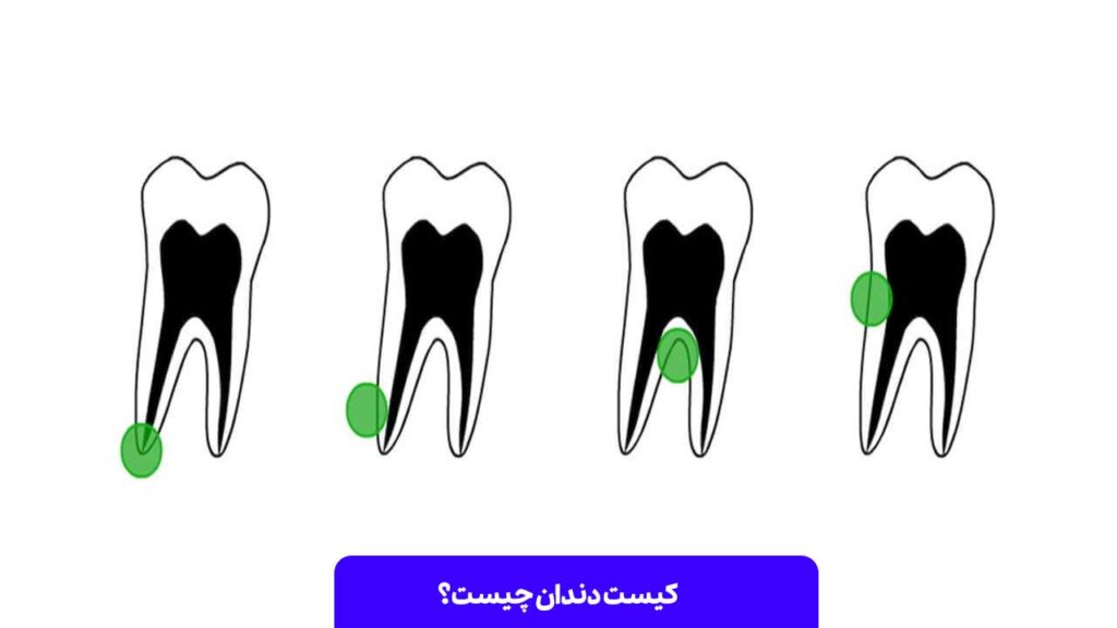 کیست دندان چیست؟