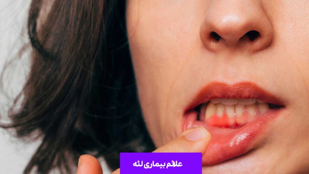 علائم بیماری لثه