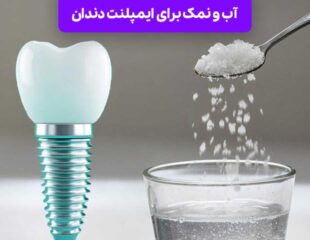 آب و نمک برای ایمپلنت دندان